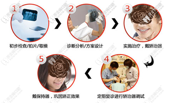 地包天牙齒矯正的步驟流程