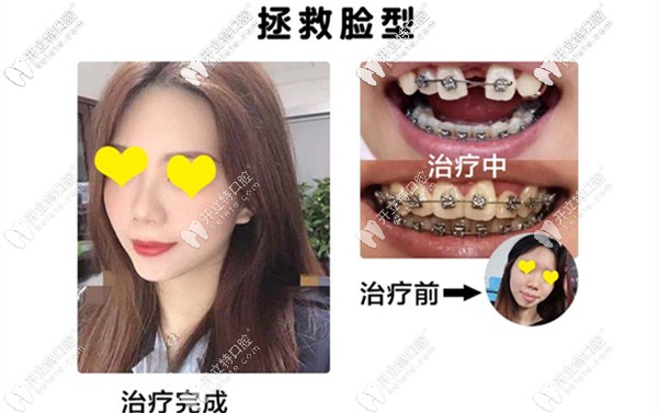 門牙多生牙矯正效果圖
