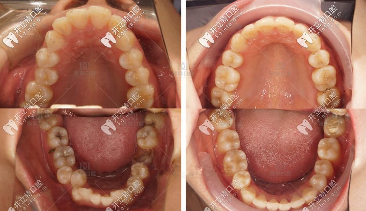 歐巴的口內(nèi)照，牙齒齊了很多撒