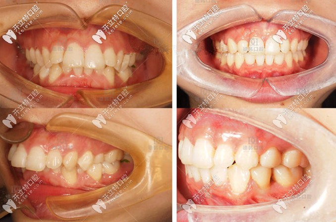 齙牙矯正前后對(duì)比圖