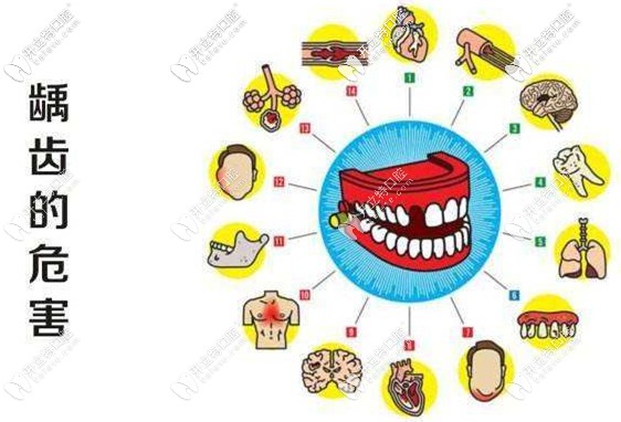 齲齒自然也會影響兒童的牙齒