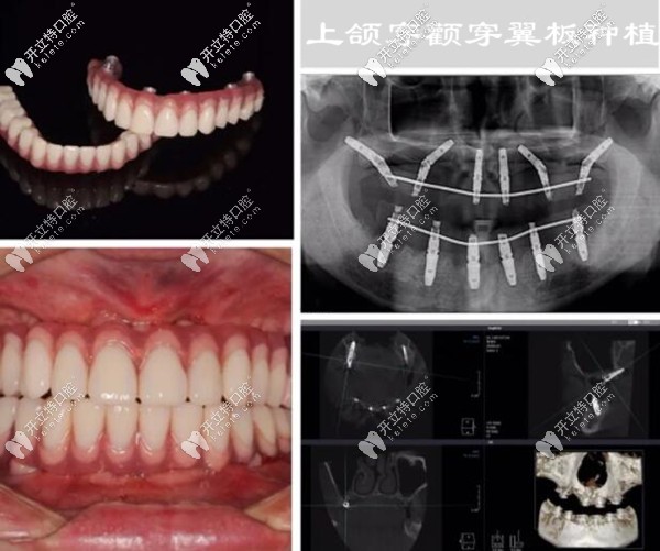 我在深圳登緹斯口腔做穿顴穿翼板種植牙后的效果