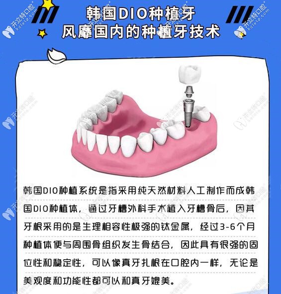 韓國(guó)DIO種植牙怎么樣 韓國(guó)DIO種植牙怎么樣