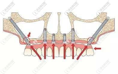 什么是穿顴穿翼板種植牙技術(shù)