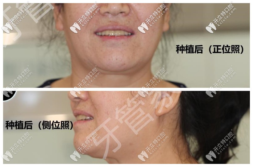 張姨半口6顆種植牙的圖片正面和側(cè)面照片