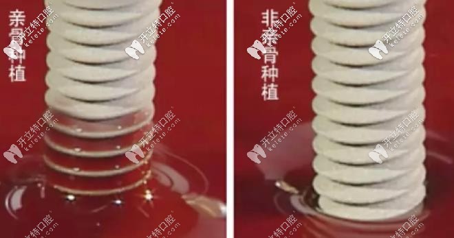 親骨種植和非親骨種植技術(shù)對比