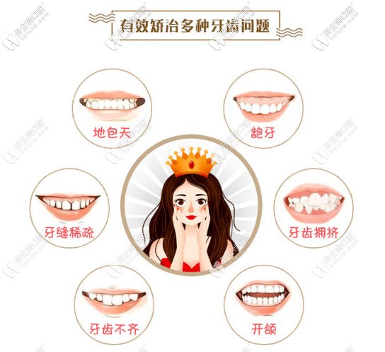 時(shí)代天使可矯正的牙齒不齊類(lèi)型