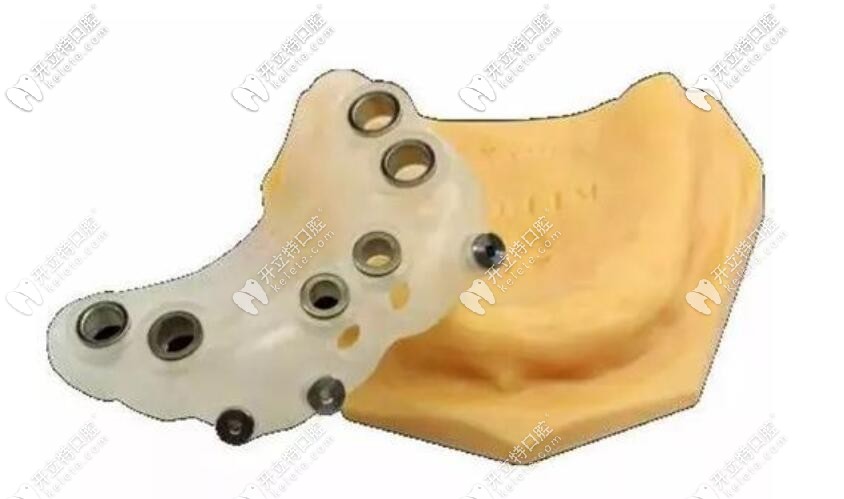 種植牙時用的導(dǎo)板