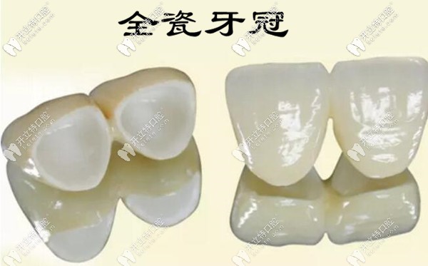 烤瓷牙邊緣發(fā)黑的修復(fù)方法