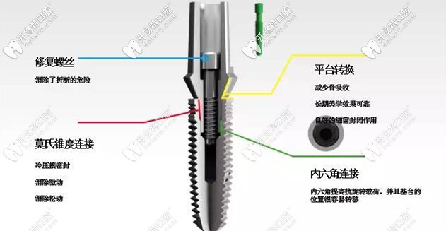 選擇種植牙，方方面面都要考慮到位