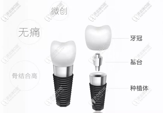種植牙的咬合力是非常接近真牙的