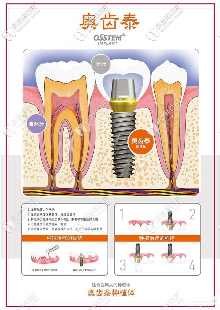 韓國奧齒泰種植牙的優(yōu)勢