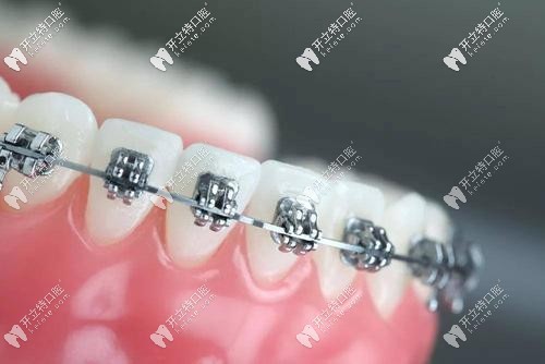 金屬托槽矯正外觀