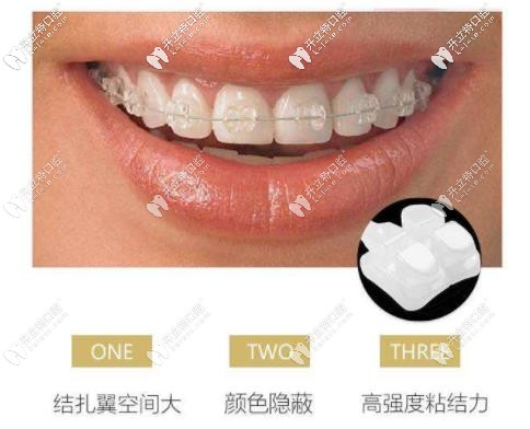 陶瓷半隱形矯正