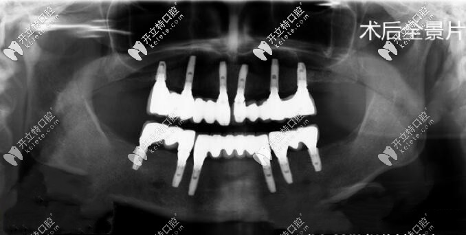 請(qǐng)問北京維嘉口腔怎么樣?想做全口種植牙去這家牙科靠譜嗎