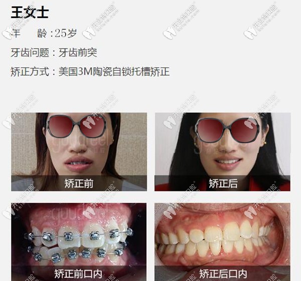 深圳格倫菲爾口腔牙齒前突矯正案例