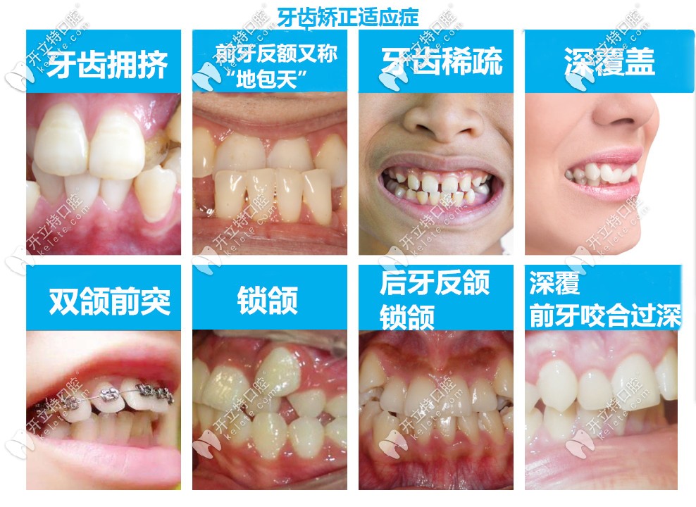 牙齒不齊的類型