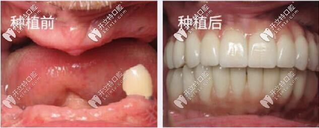 全口種植牙前后圖