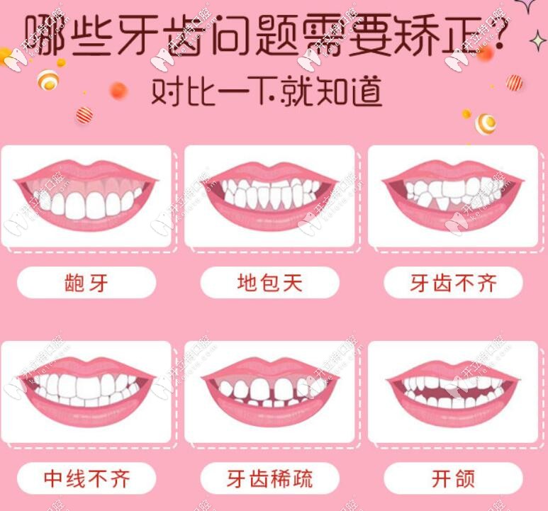 搞不清楚自己需不需要整牙，對比下就知道