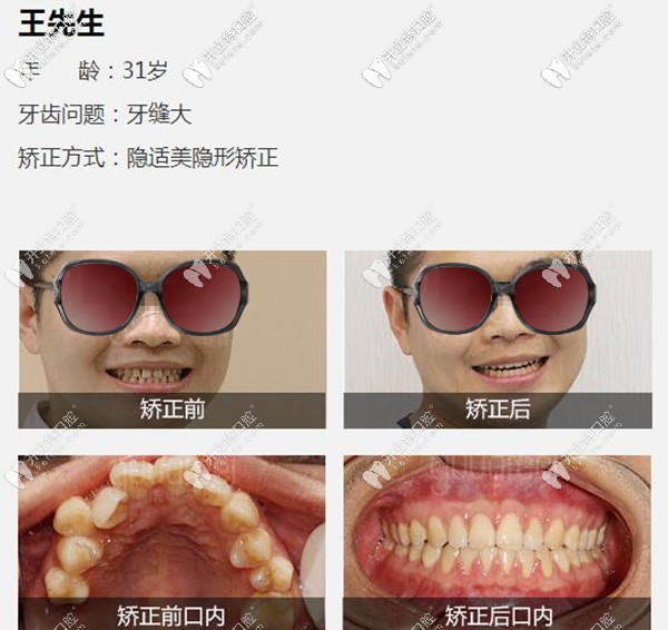 深圳格倫菲爾口腔隱適美牙齒矯正案例