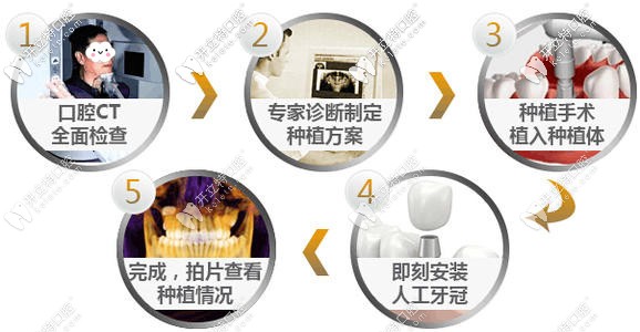 種植牙的過程