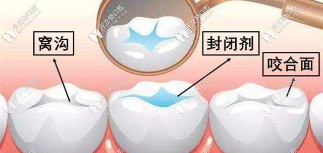 窩溝封閉可以有效預防齲齒