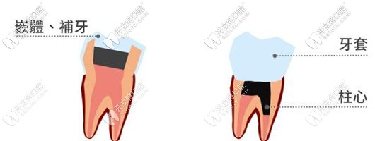 深齲可以采取嵌體治療