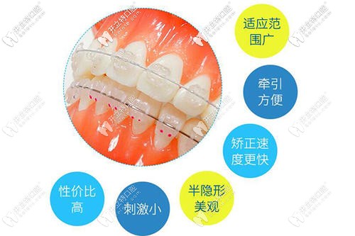 半隱形矯正優(yōu)點