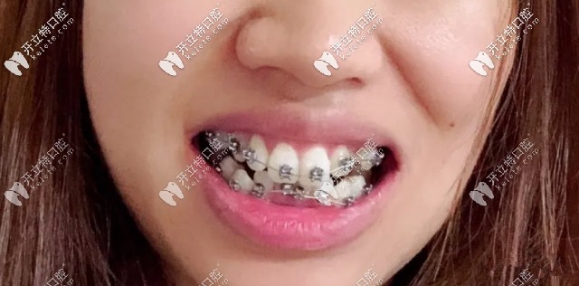 剛帶上牙套的時候