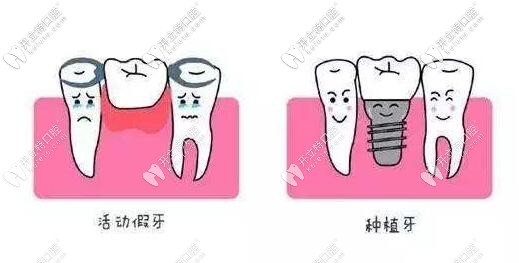 活動(dòng)假牙和種植牙哪個(gè)好