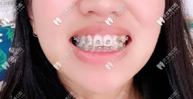 快該摘掉牙套啦，牙齒已經(jīng)排齊了