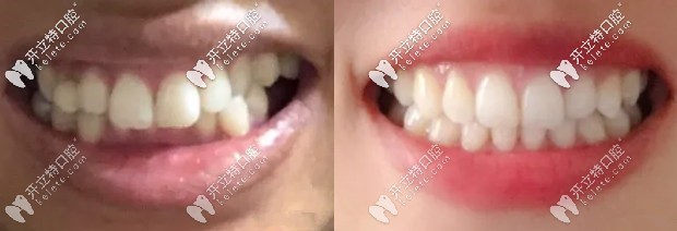 深覆合矯正前后效果圖