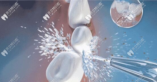 超聲波潔牙 超聲波潔牙