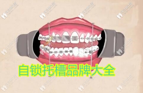 金屬自鎖牙套品牌大全匯總,說說國產(chǎn)和進(jìn)口到底有啥區(qū)別？