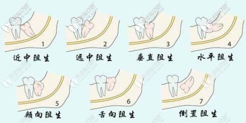 各類智齒的種類 各類智齒的種類