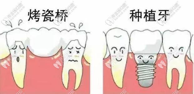 烤瓷牙和種植牙對比 烤瓷牙和種植牙對比