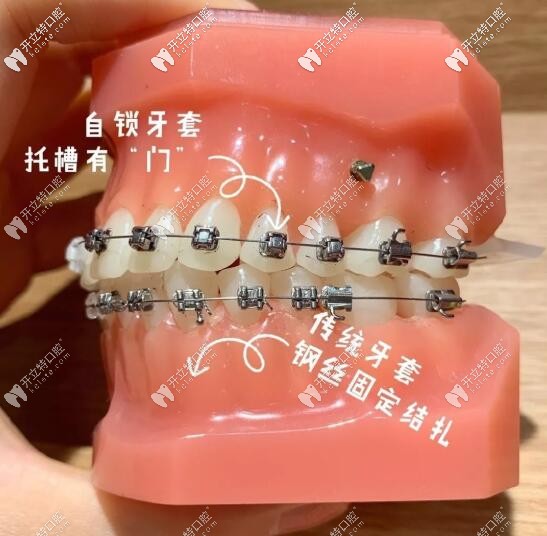 自鎖和非自鎖托槽的區(qū)別