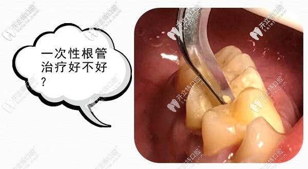 有關一次性根管治療步驟和適應癥你知多少？