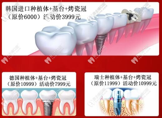蘭州韓美齒科種植牙價格 蘭州韓美齒科種植牙價格