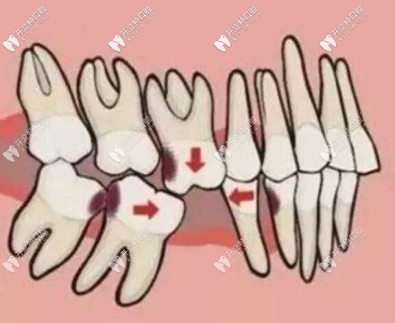 牙齒缺失不修復(fù)的危害 牙齒缺失不修復(fù)的危害