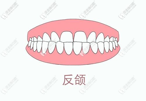反頜   