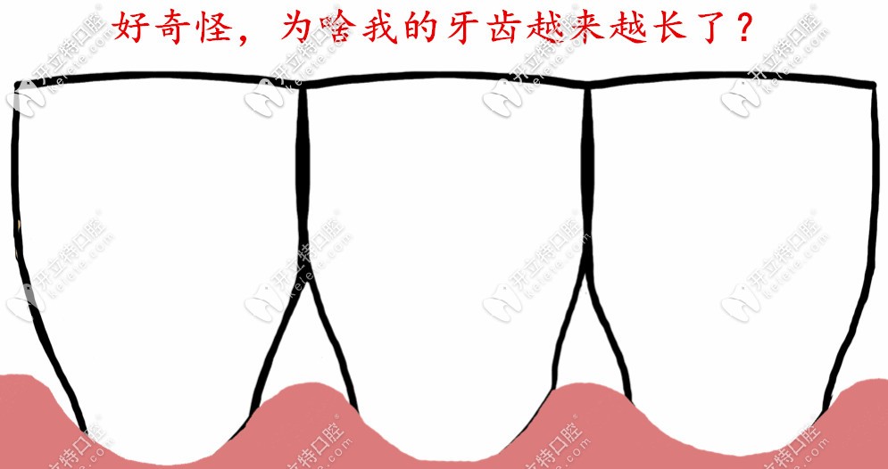 醫(yī)生，為什么我感覺牙齒越來越長了？