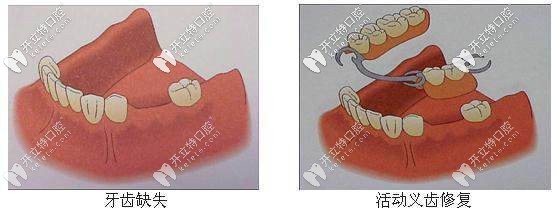 活動義齒修復(fù) 活動義齒修復(fù)