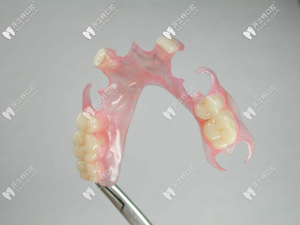 活動假牙種類 活動假牙種類