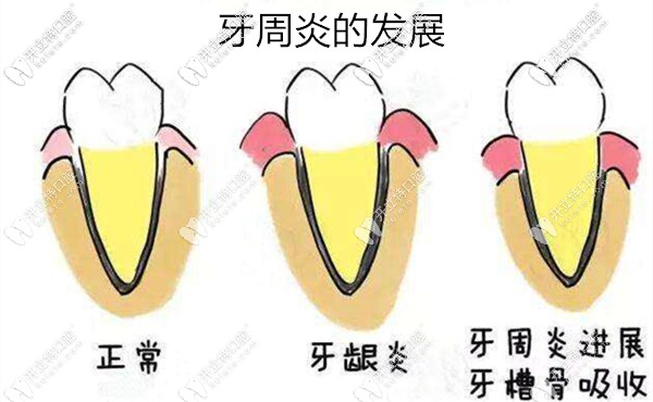 98%的人都不知道為什么年輕人會(huì)得牙周炎,更不知該怎么治療