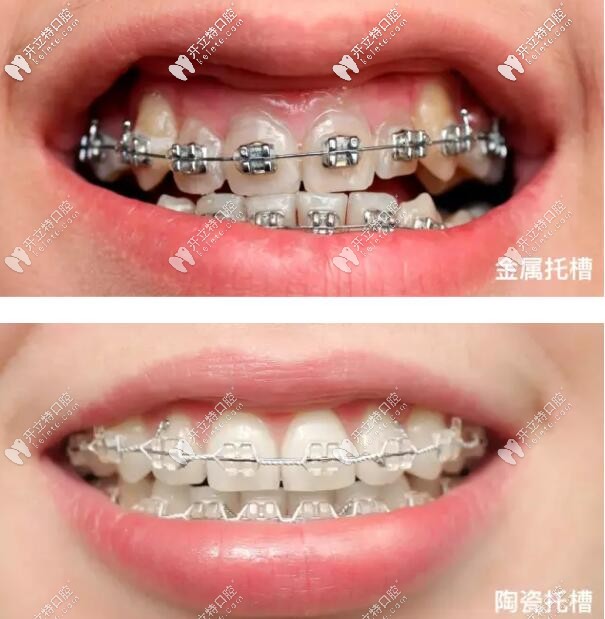 金屬托槽和陶瓷托槽圖片 金屬托槽和陶瓷托槽圖片