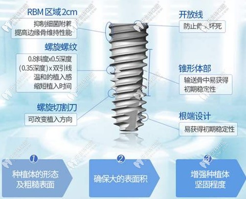種植牙的特點(diǎn)