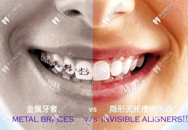 金屬托槽和隱形無托槽牙套圖片 金屬托槽和隱形無托槽牙套圖片