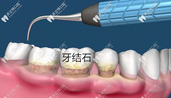 牙結(jié)石是牙周炎的致病因