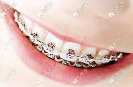 傳統(tǒng)金屬矯正的好處